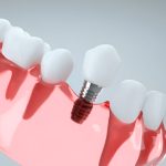 Dental Implants Keep Up with Your Lifestyle